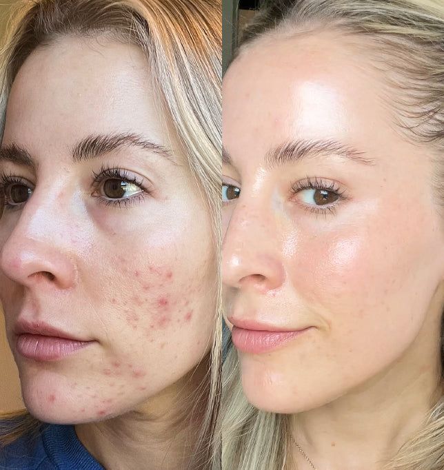 Morpheus8 Results - Tighten and Sculpt