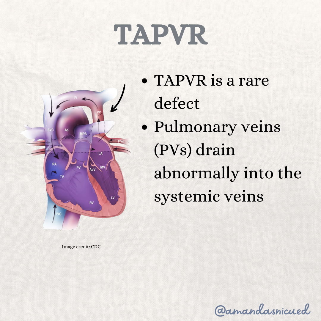 Diagram of total anomalous pulmonary venous return (TAPVR) showing pulmonary veins draining into the right atrium instead of the left atrium in a newborn heart. Diagram of total anomalous pulmonary venous return (TAPVR) showing pulmonary veins draining into the right atrium instead of the left atrium in a newborn heart.
