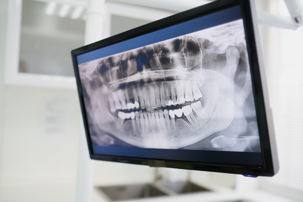 What Happens If You Wait Too Long to Replace a Missing Tooth?