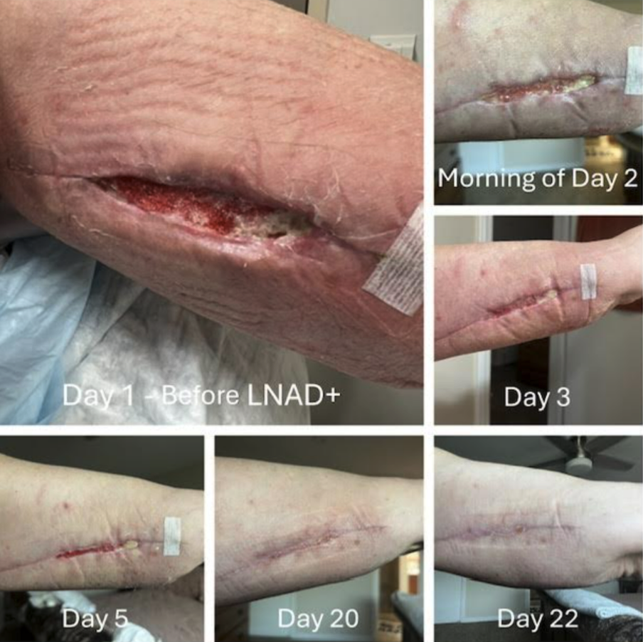 LathMized NAD+ wound healing case study — Day 1 through Day 22