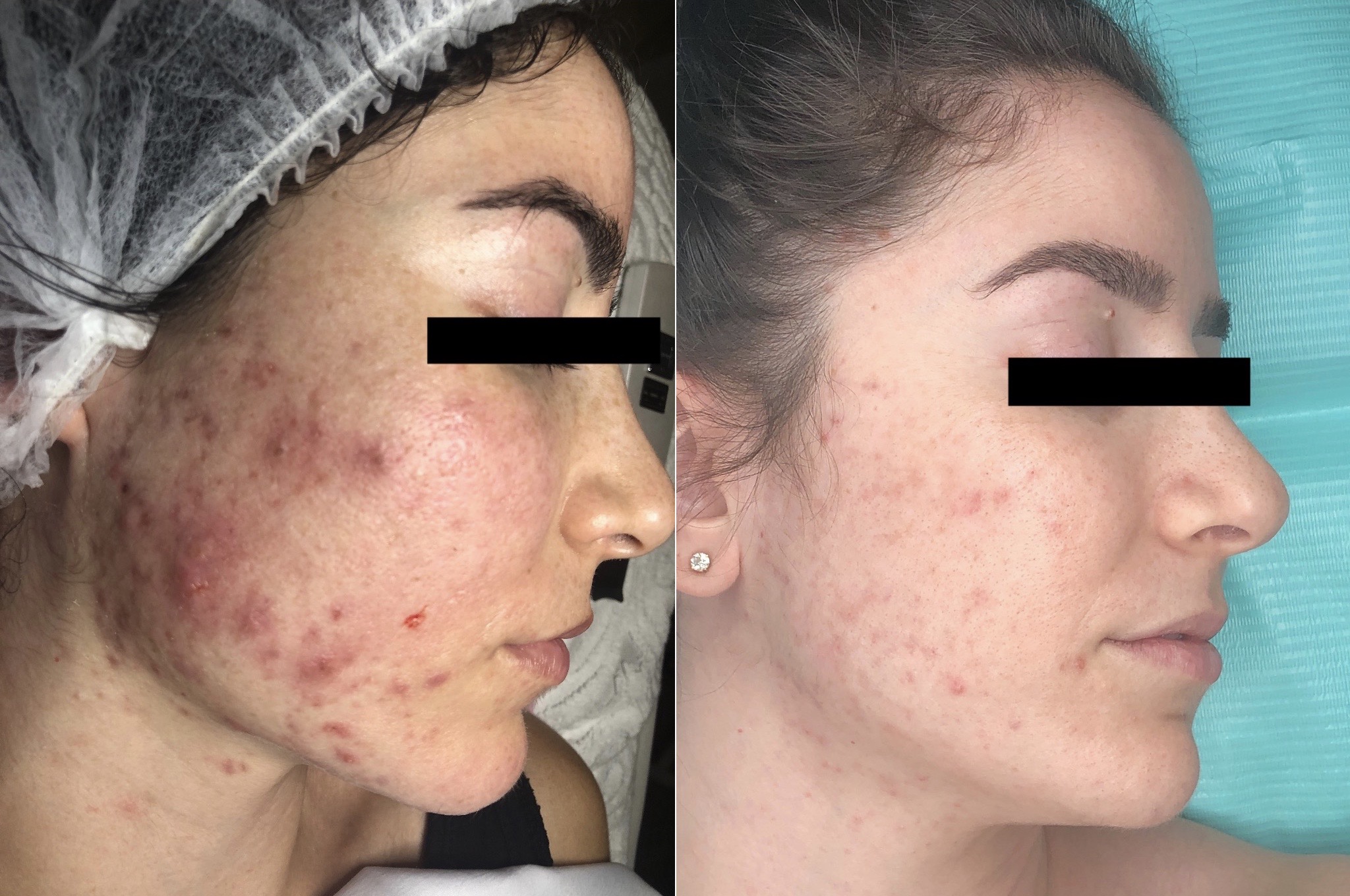 Acne & Clear Skin Solutions Midtown Miami