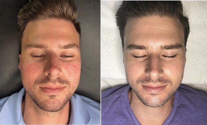 Teen Skincare Midtown Miami