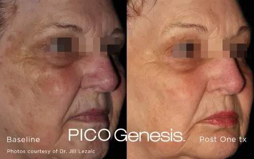 MediGlow melasma before and after, stage 1