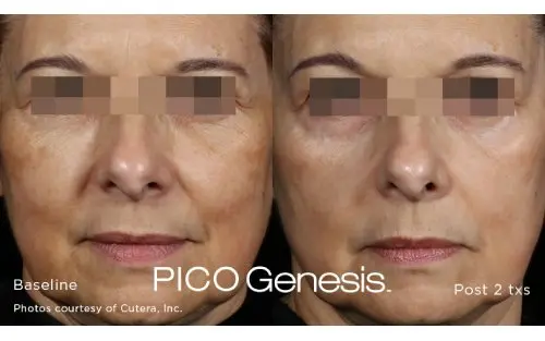 MediGlow melasma before and after, stage 3