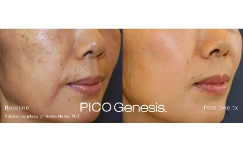 MediGlow melasma before and after, stage 2
