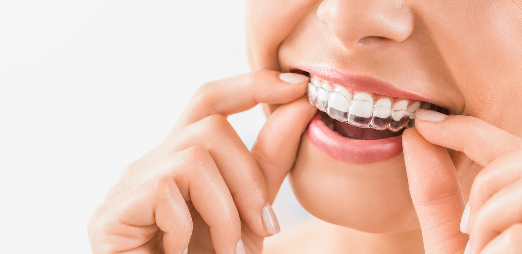 Clear Aligners