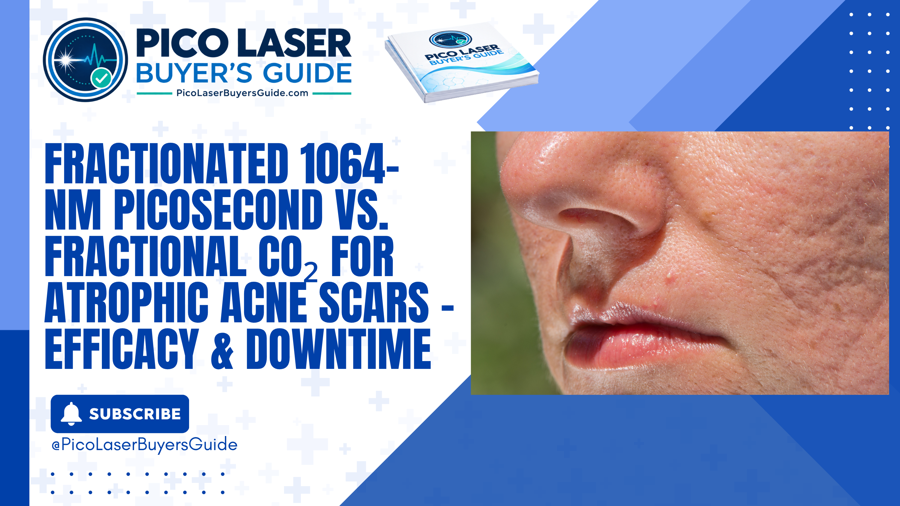 Video thumbnail: Fractionated 1064-nm Picosecond vs. Fractional CO₂ for Atrophic Acne Scars