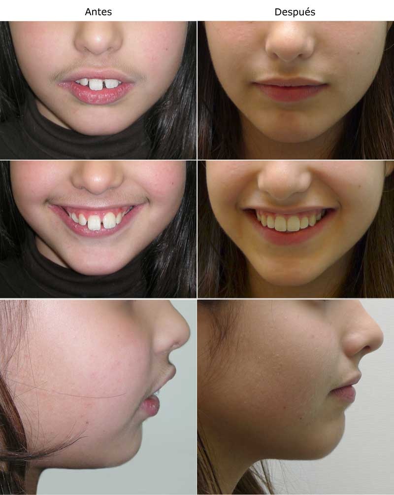 Resultado de ortodoncia OdontoNordelta