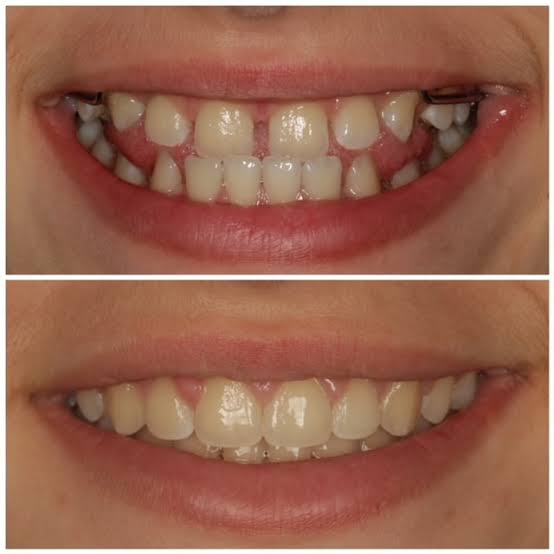 Ortodoncia y alineación dental OdontoNordelta