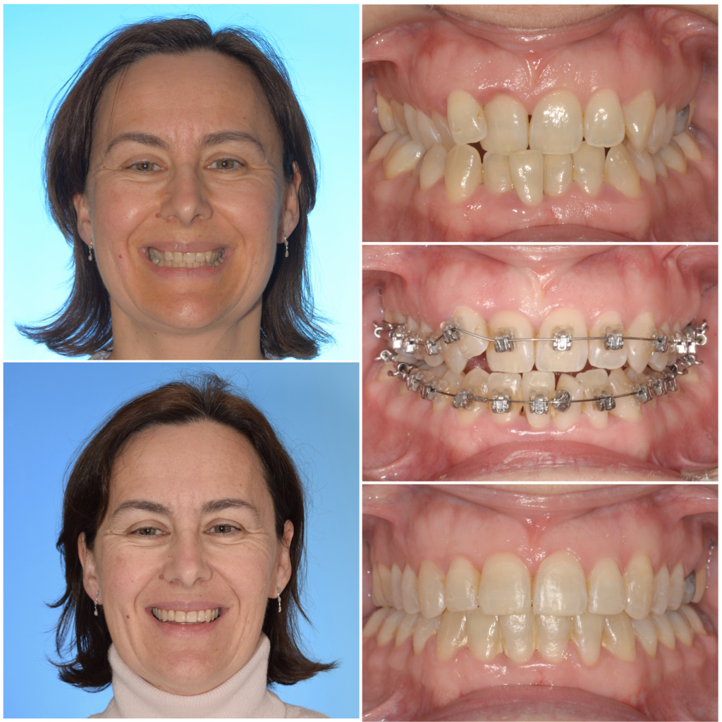 Tratamiento de ortodoncia OdontoNordelta