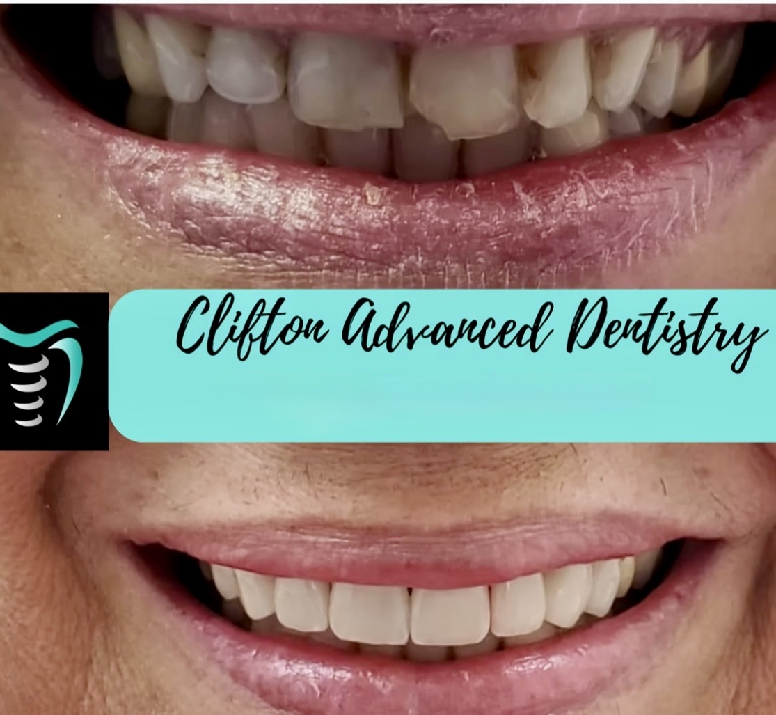 smile makeover before and after Clifton NJ
