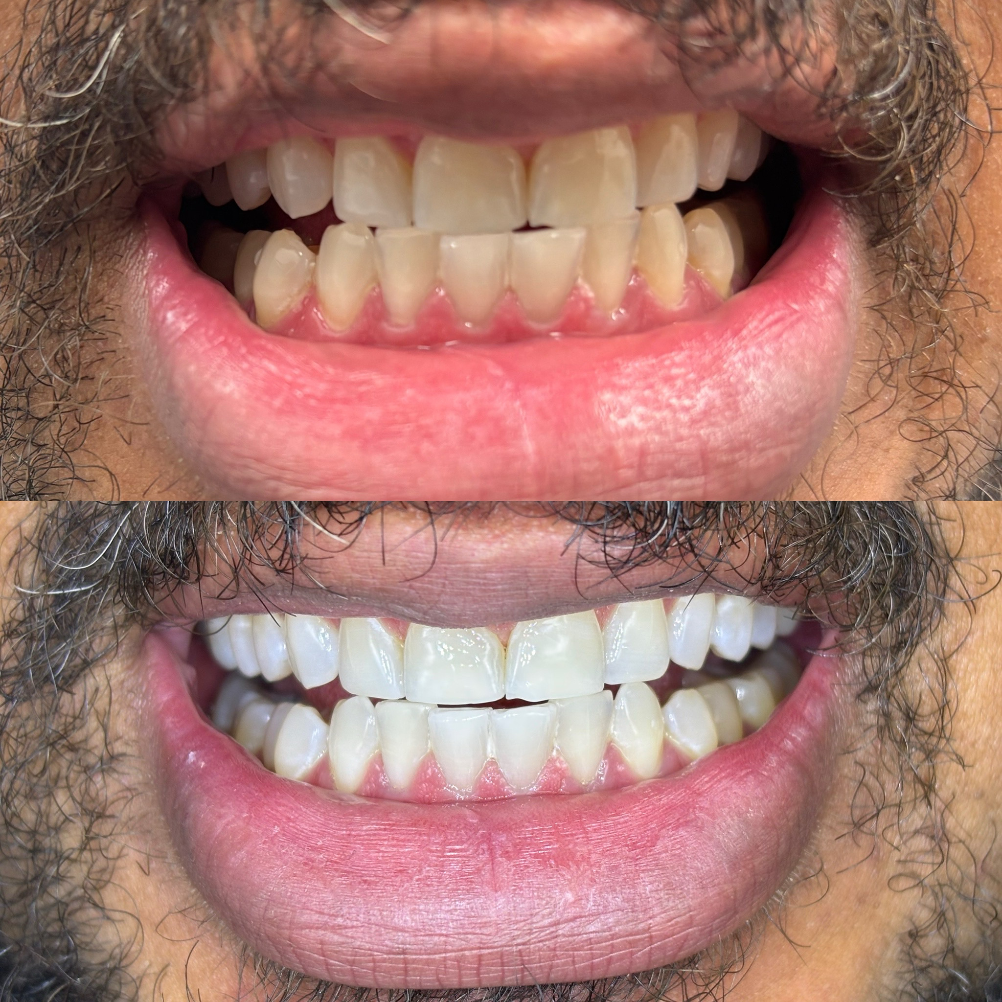 cosmetic dentistry before and after Clifton NJ