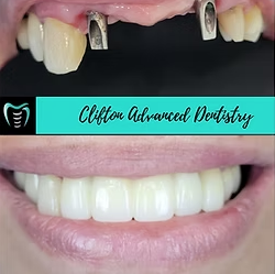 veneers and smile makeover result Clifton NJ