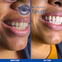 Before and After | All-White Teeth Whitening Marietta GA