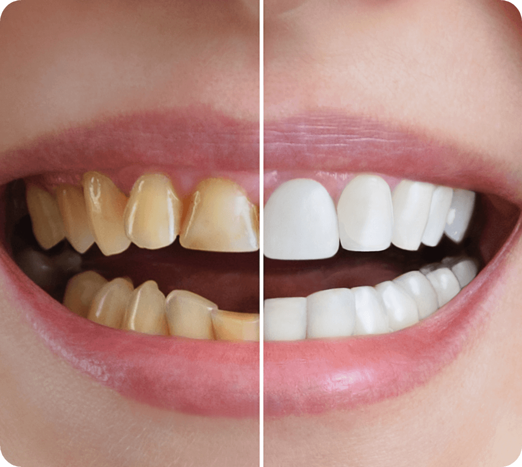 Before and after teeth whitening showing stained teeth transformed into a bright white smile