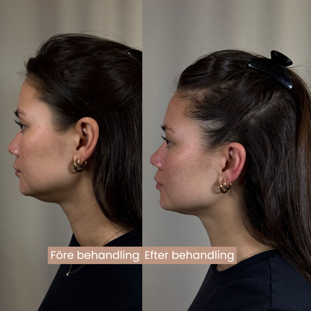 Före och efter kombobehandling av käklinjen hos RF Kliniken