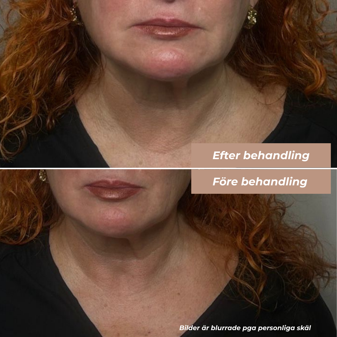 Före och efter kombobehandling av hals och käklinje hos RF Kliniken