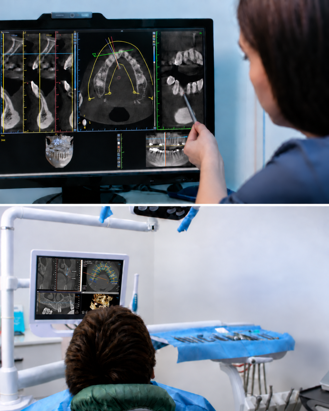 Anonymised CBCT implant-planning view used for guided-surgery design