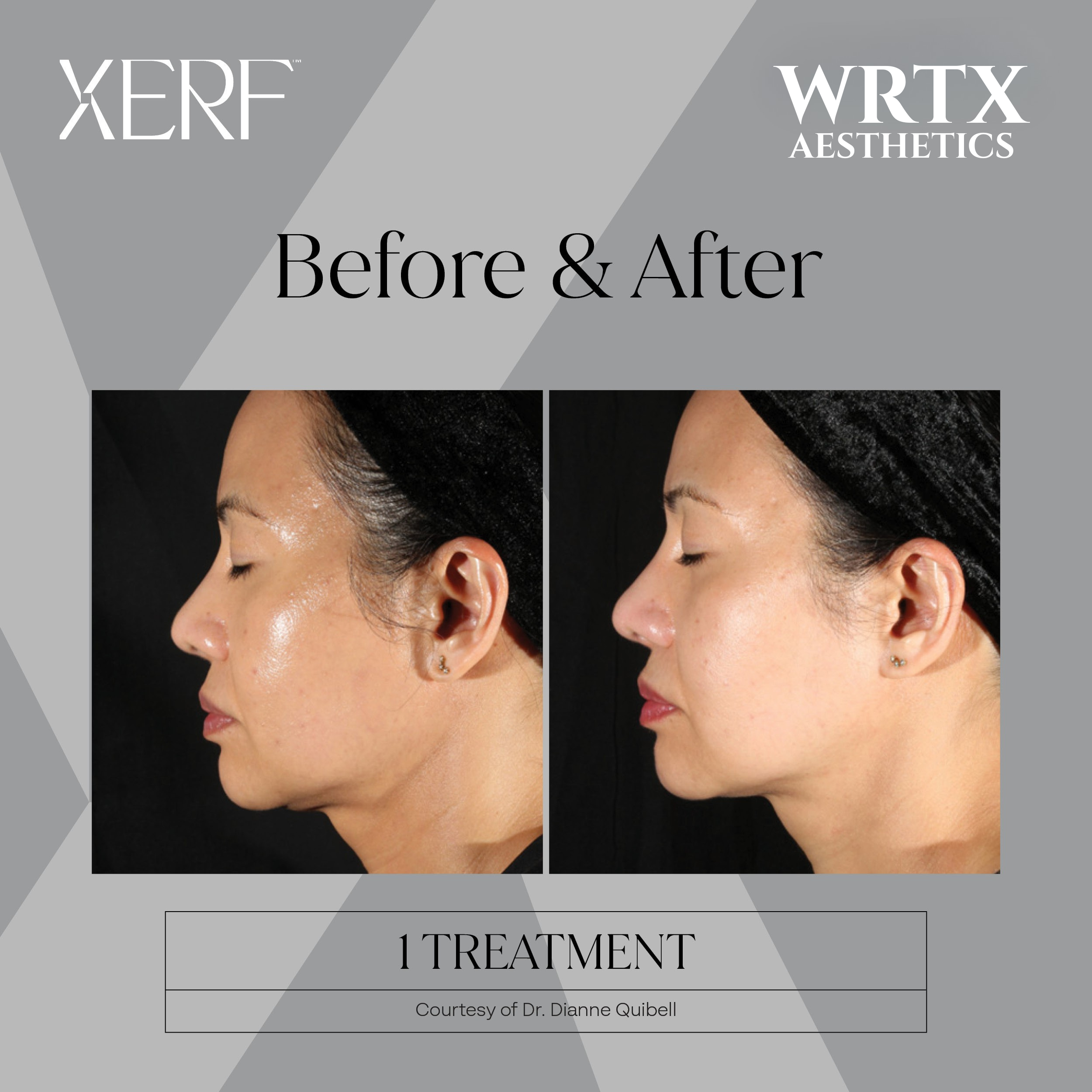 XERF before and after real patient result