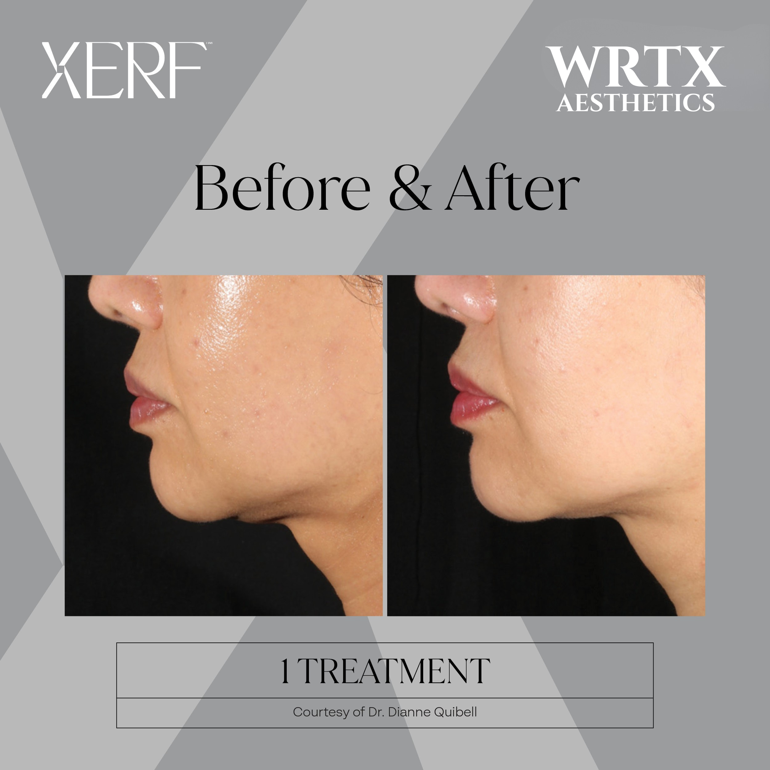 XERF before and after close-up result, one treatment