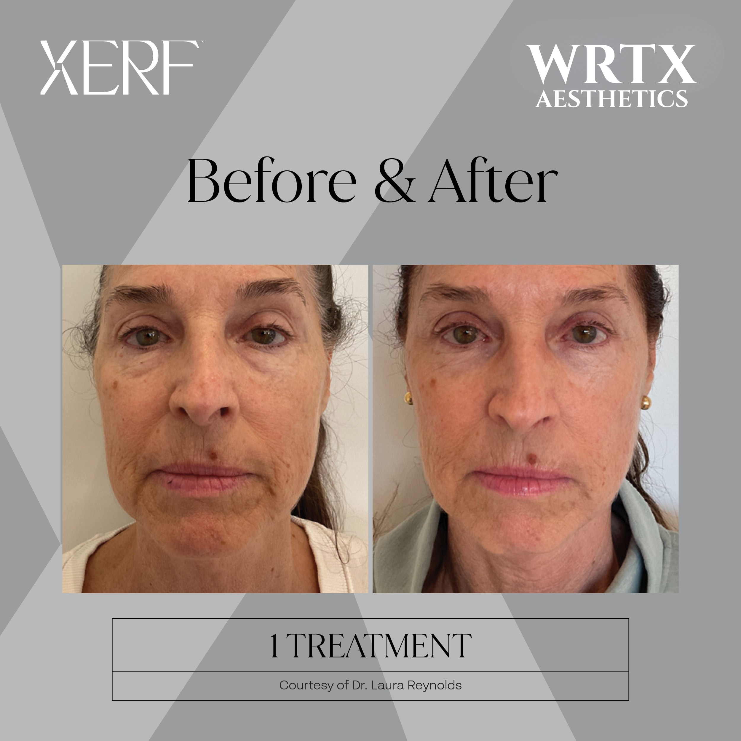 XERF before and after neck result, one treatment