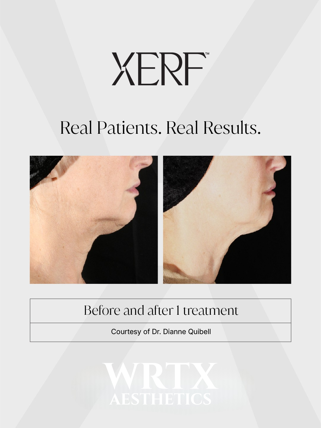 XERF before and after result