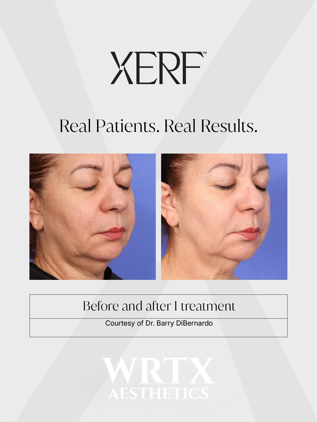 XERF before and after result, one treatment