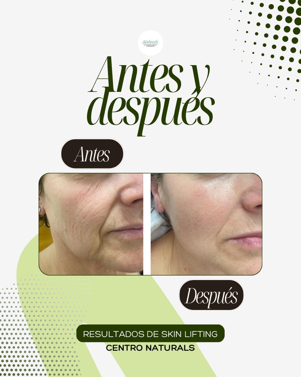 Antes y después Skin Lifting