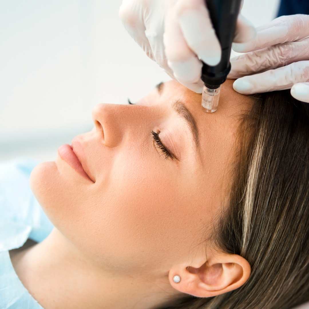 Microneedling service