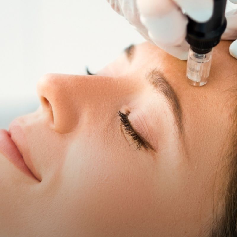 Waxing Queen of Tucson patient receiving microneedling treatment
