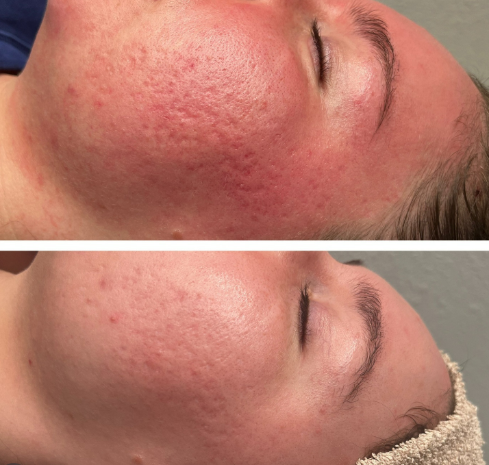 Waxing Queen of Tucson before and after Microneedling results