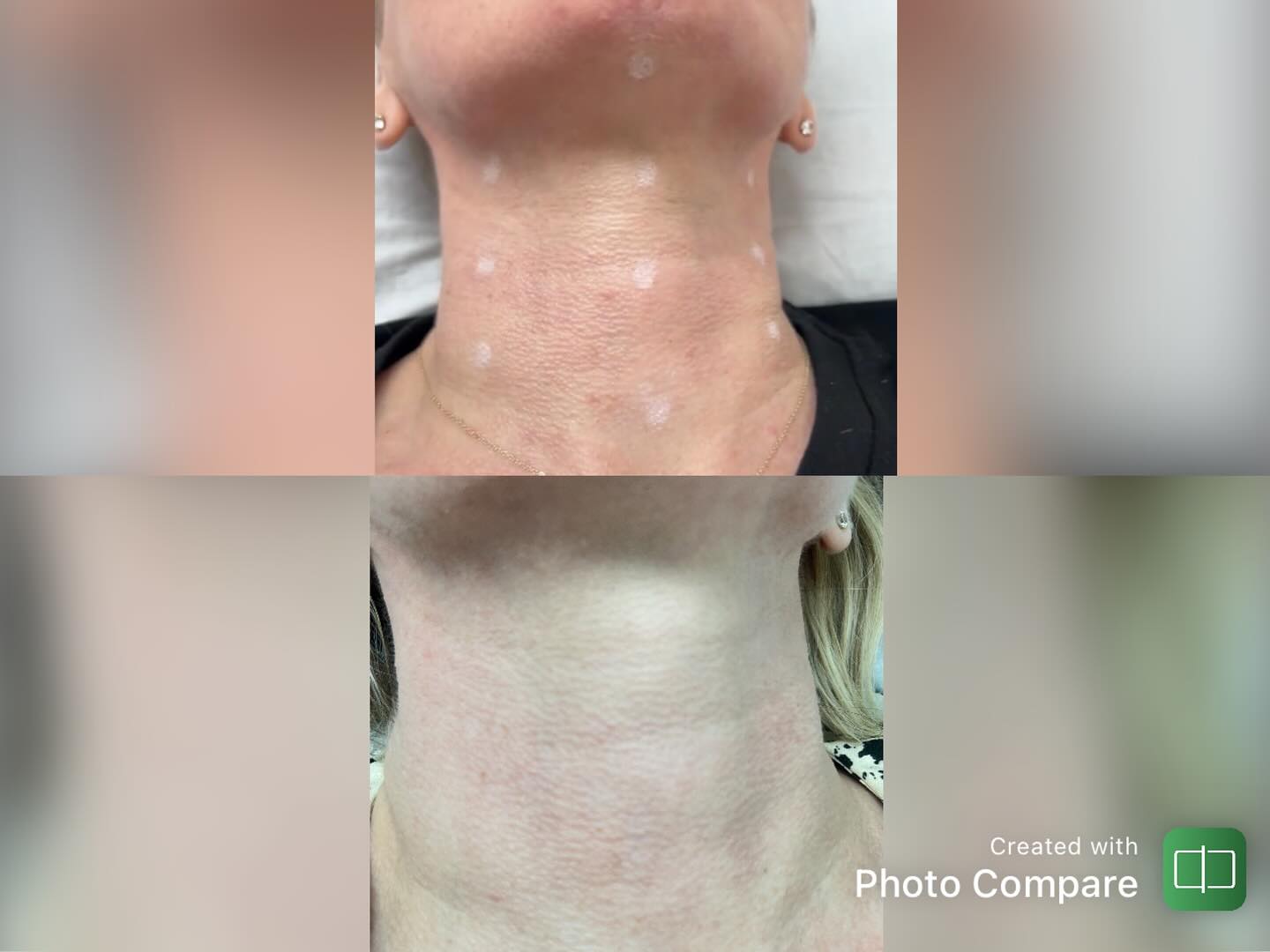 The neck comparison shared in Star Aesthetics’ May 2025 Instagram post.