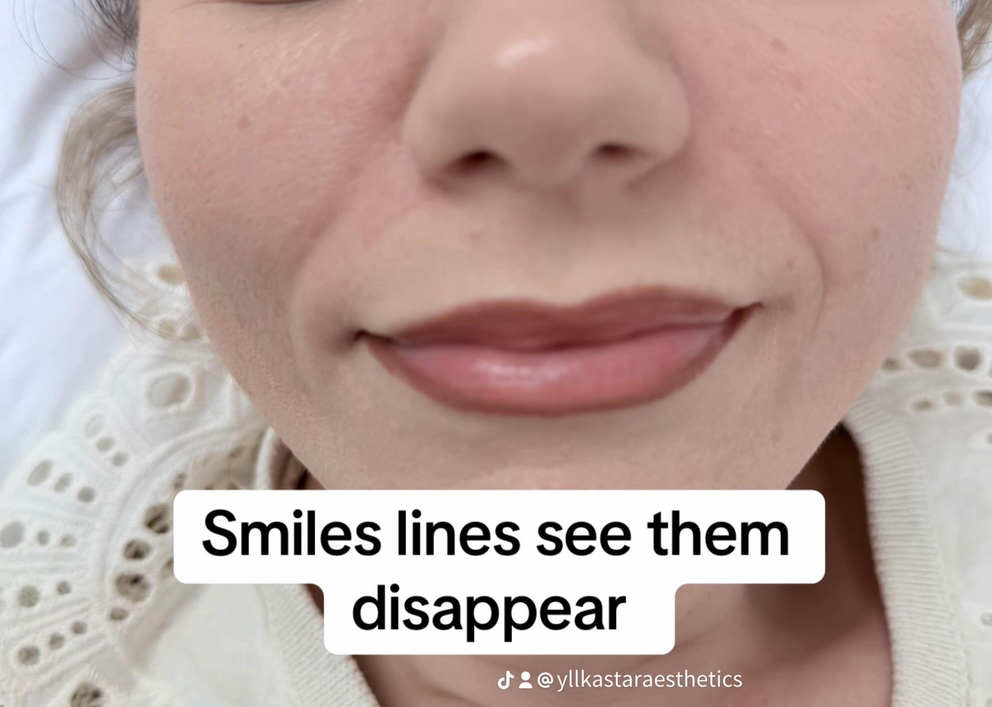 A Star Aesthetics photograph with an on-image caption about smile lines.