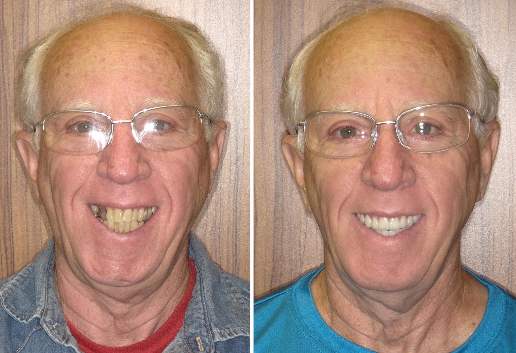 Before and After dental implants result 1