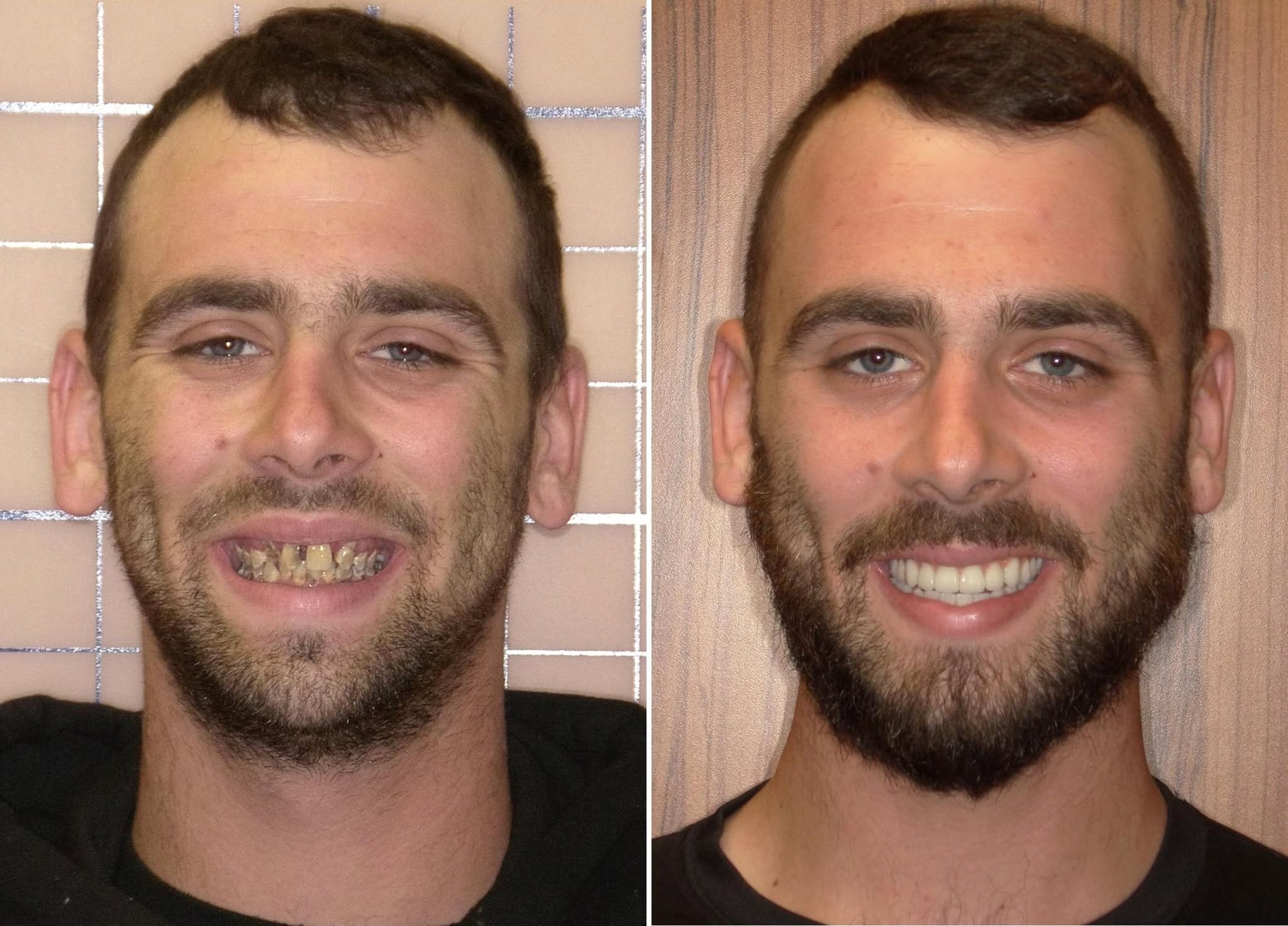 Before and After dental implants result 3