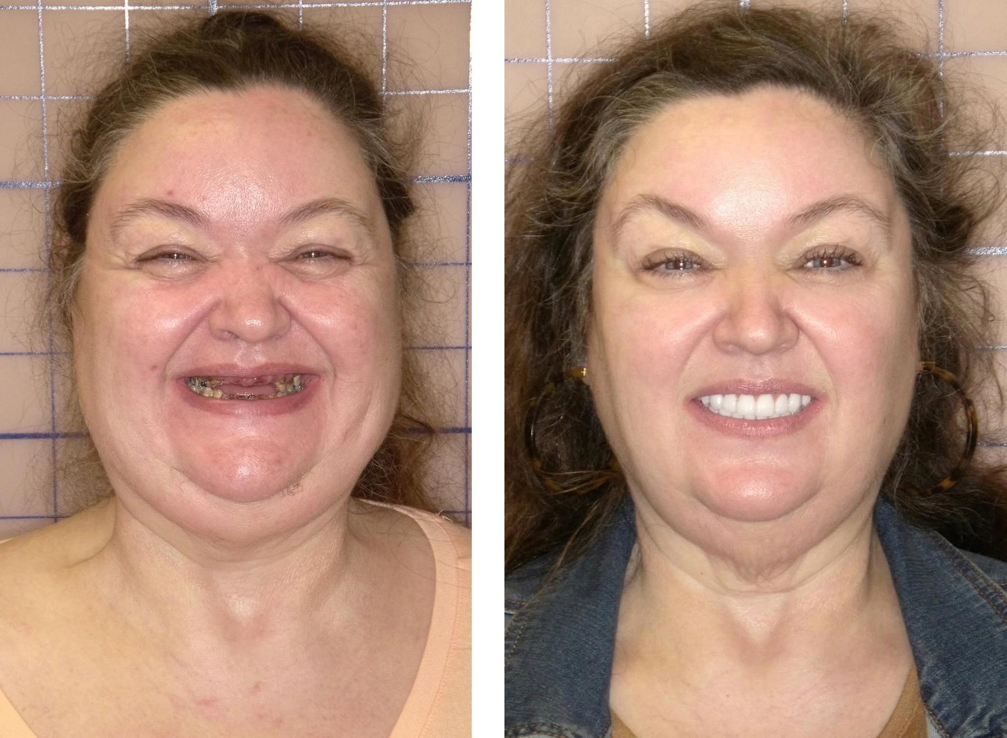 Before and After dental implants result 2