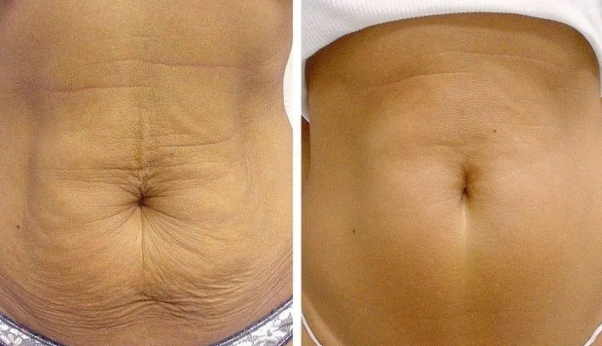 Before and after: loose-looking abdominal skin visibly firmer after body sculpting at Stuart MedSpa
