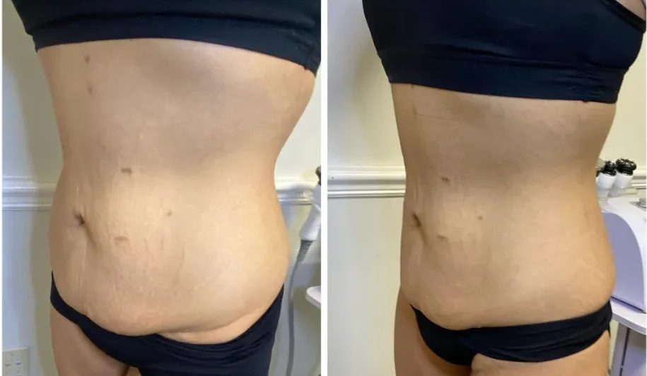 Before and after: abdomen flatter and tighter-looking after body sculpting at Stuart MedSpa