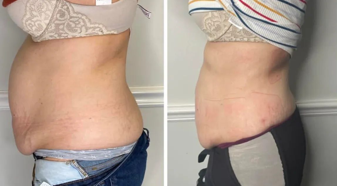 Before and after side profile: visibly smoother after body sculpting at Stuart MedSpa
