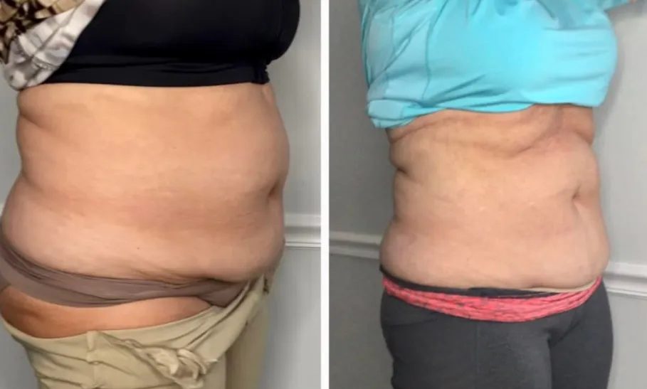 Before and after: stubborn belly sculpted down at Stuart MedSpa