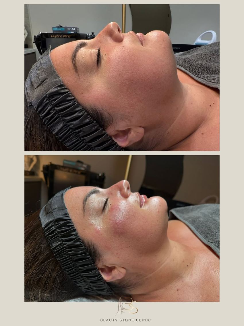 Real client of Beauty Stone Clinic, before and after Geneo X
