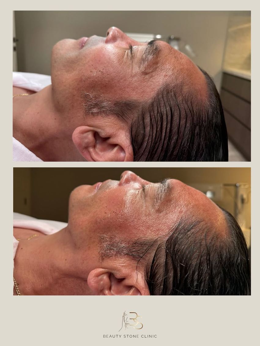 Real client of Beauty Stone Clinic, before and after Geneo X