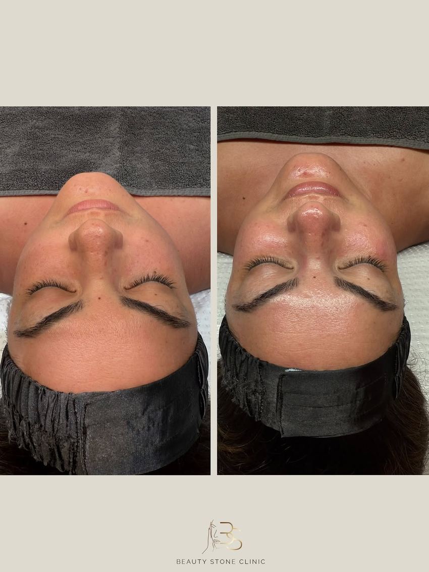 Real client of Beauty Stone Clinic, before and after Geneo X