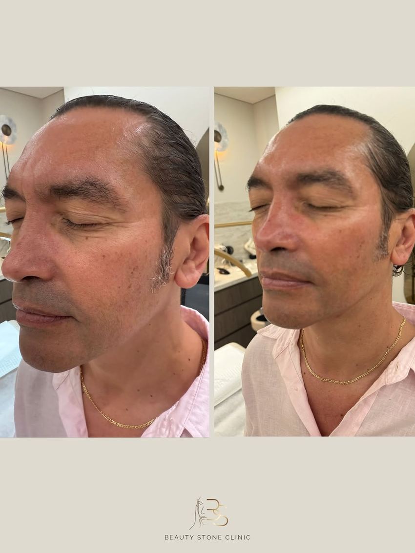 Real client of Beauty Stone Clinic, before and after Geneo X