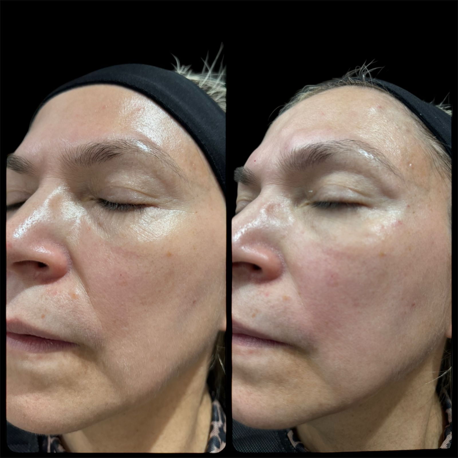 Tratamiento dermatológico para firmeza sin cirugía