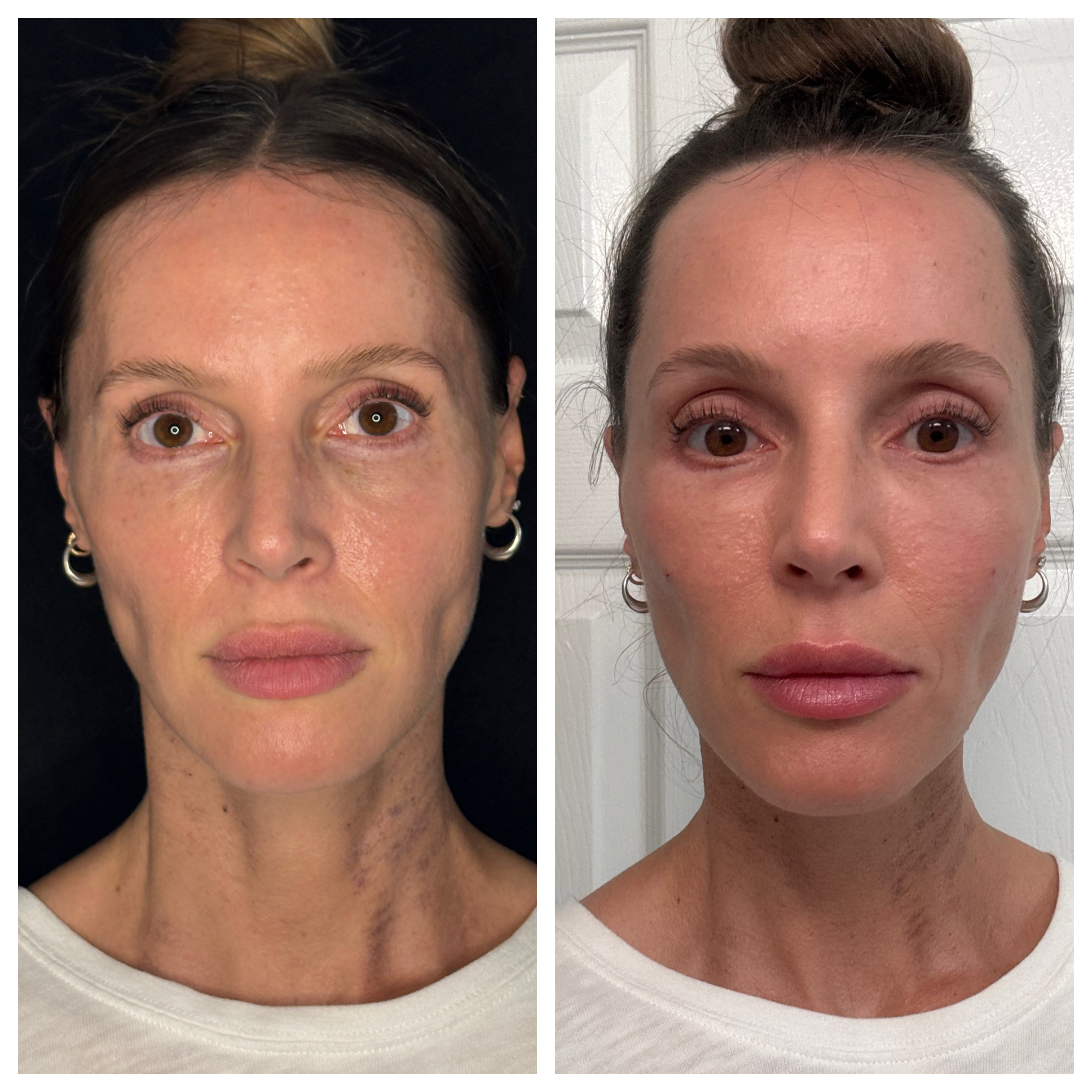 Facial Rejuvenation Before and After