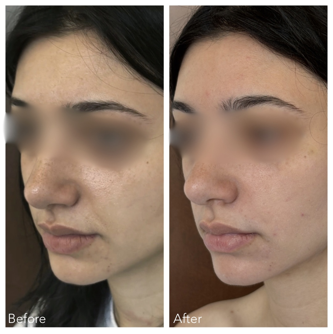 Pyriform Support Smoothing Smile Lines