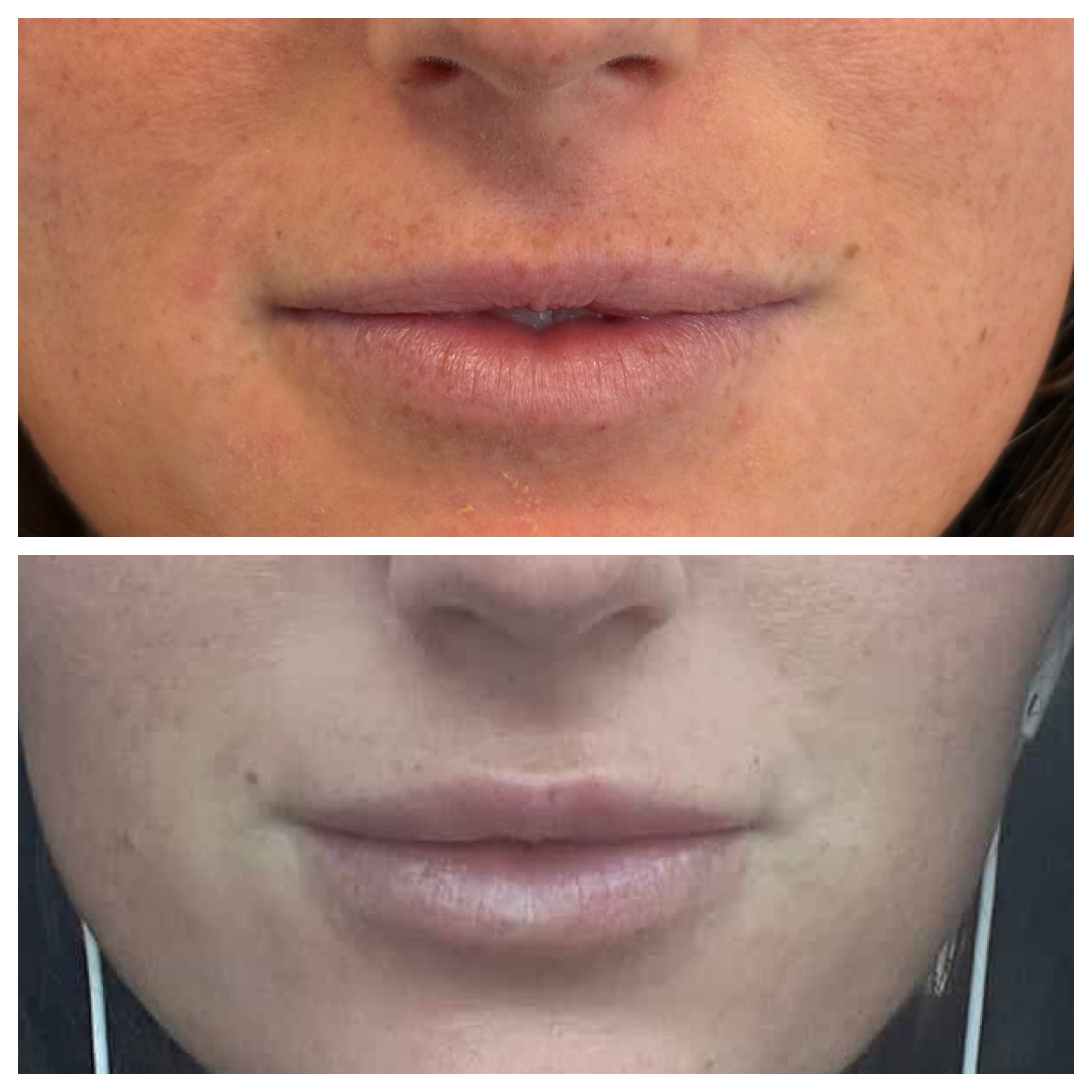Lip Filler Before and After