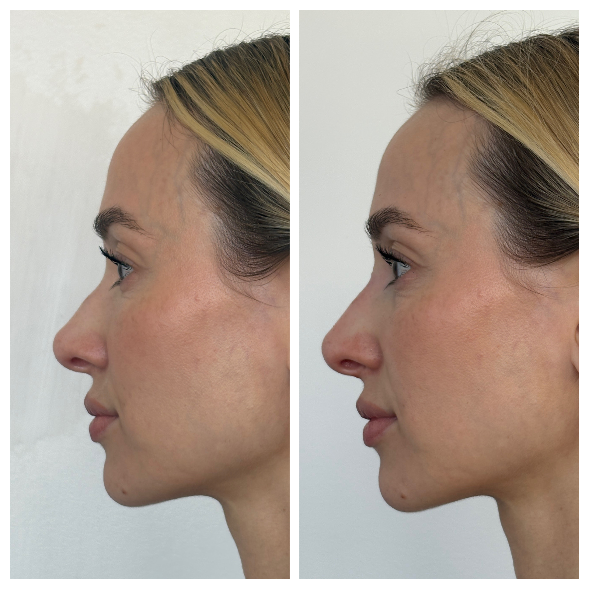 Nose Filler