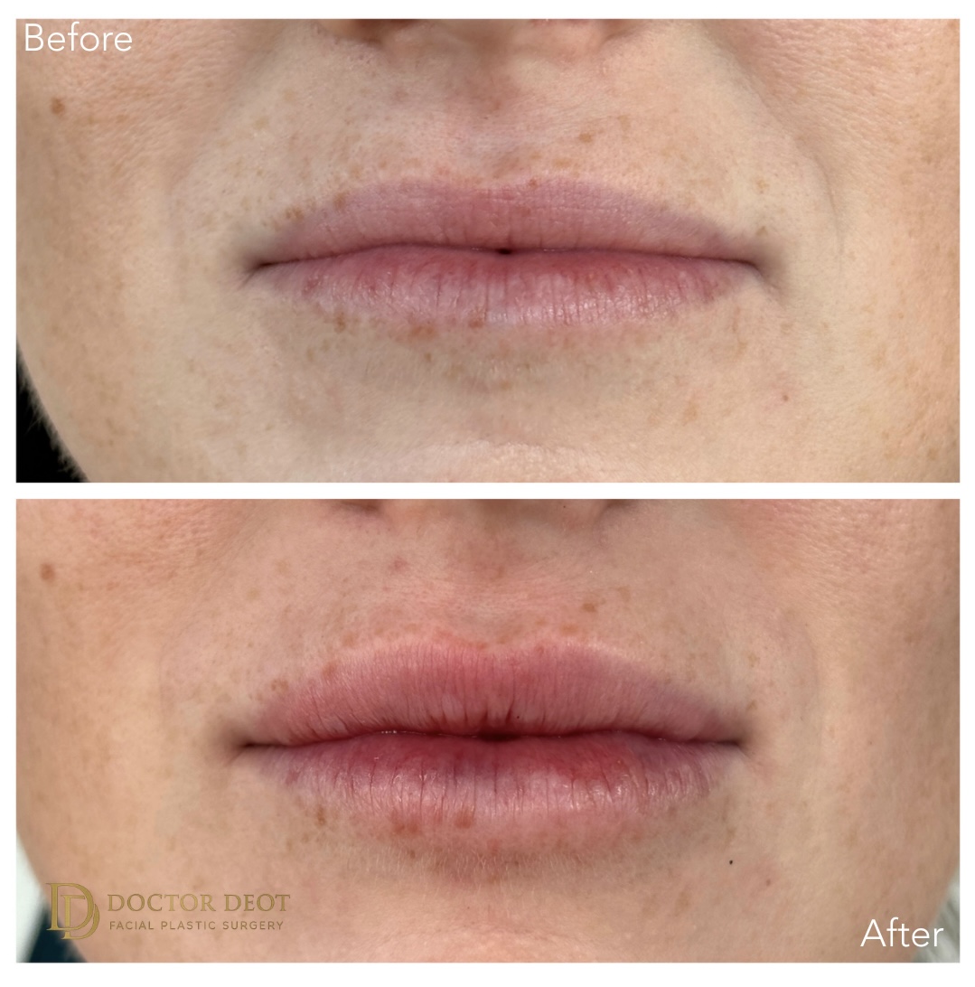 Lip Filler
